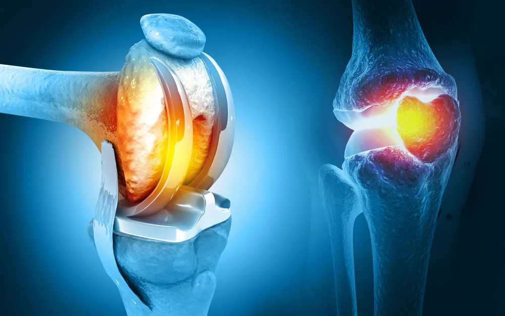 Orthopedic & Joint Replacement Surgery