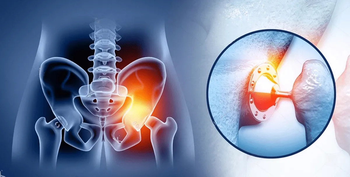Total Hip Replacement