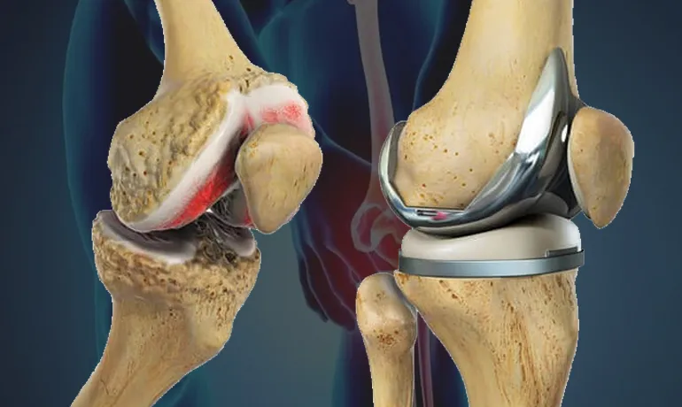Total Knee Replacement